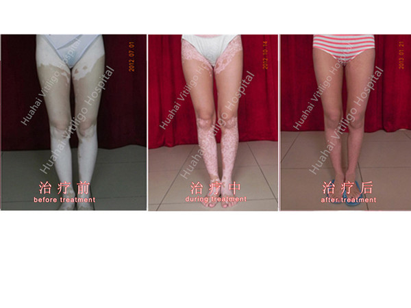 vitiligo treatment.jpg