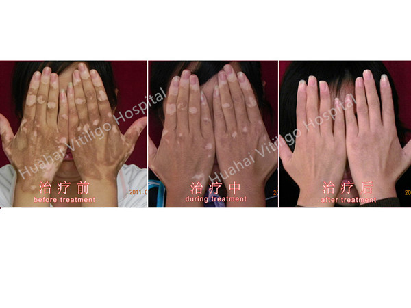 vitiligo on hands.jpg